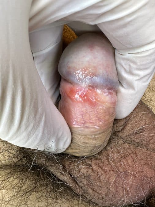Balanitis de Zoon afectando a la zona del frenillo