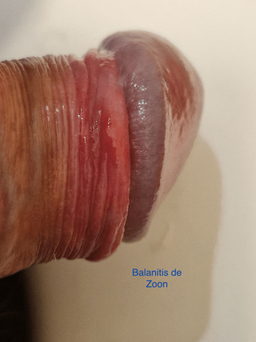 Balanitis de Zoon: síntomas y causas 1