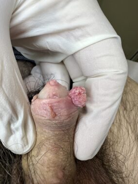 Virus del papiloma - Verrugas genitales 2