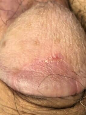 Balanitis circinada y la enfermedad celíaca