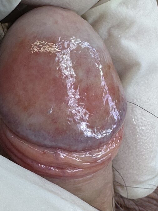 Balanitis de Zoon. Observese el brillo de la lesión que a pesar de 