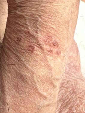 Cicatrizacion del herpes en pene, pequeñas costas