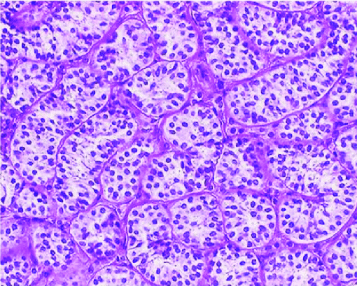 Microscopy-Sertoli-cell-tumor-with-Sertoli-cell-tubules-under-high-magnification-HE