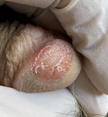 Psoriasis en pene