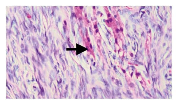 Tumor de células de Leydig del testículo 6 Tumor de células de Leydig del testículo 1