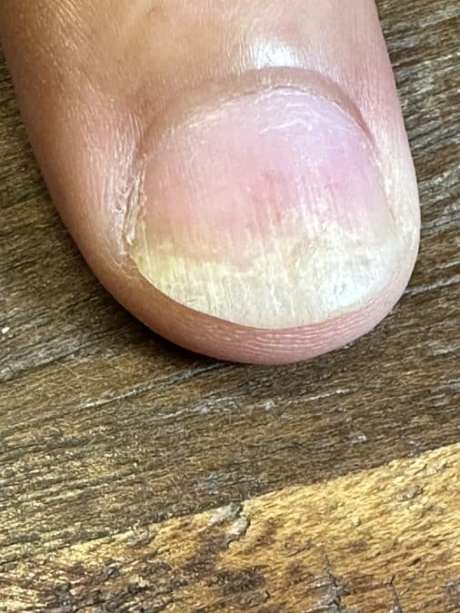 Psoriasis uña