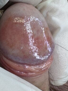 Balanitis de Zoon: lesión rojiza brillante en el glande que puede confundirse con candidiasis