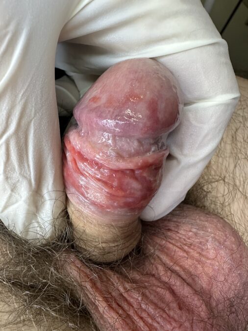 Hongos en el pene. Candidiasis en el pene con enrojecimiento del glande