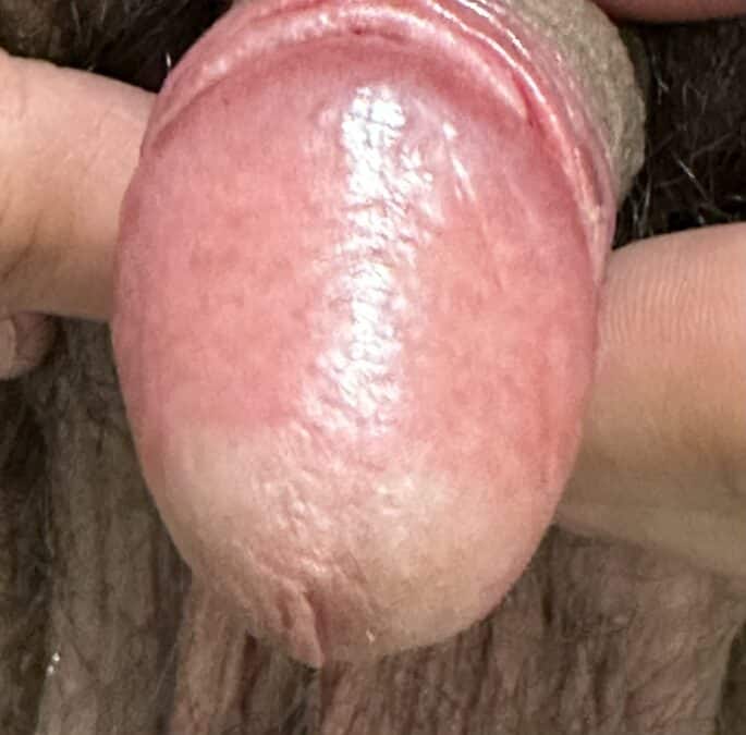 "Candidiasis genital masculina incipiente en glande tras tratamiento antibiótico con eritema leve y áreas húmedas"