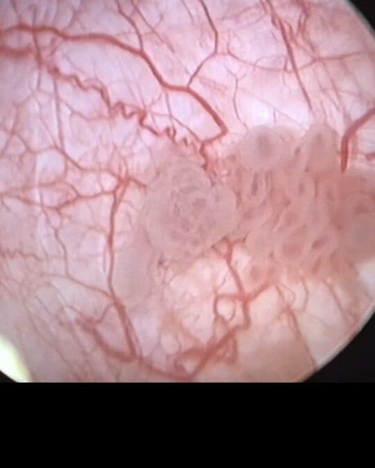 cistoscopia-tumor-vejiga “Imagen endoscópica de tumor de vejiga