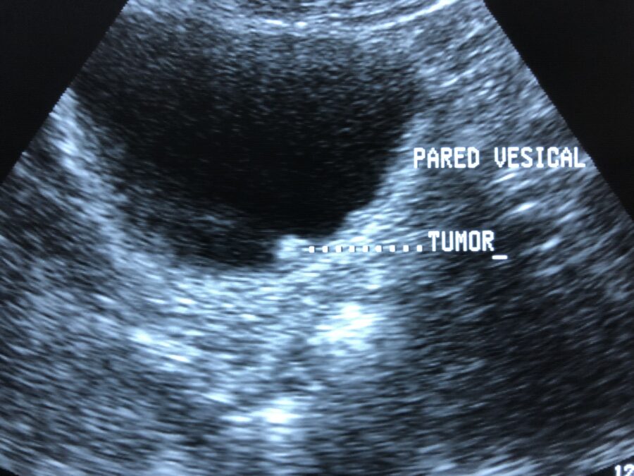 ecografia-tumor-vejiga “Ecografía de tumor de vejiga mostrando lesión vesical intraluminal”