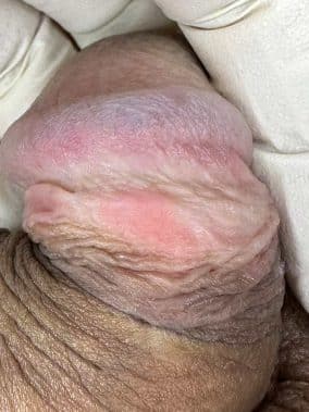 Qué hacer si mi pareja tiene el Virus del Papiloma Humano (HPV) 4 erosiones en el pene tras mantener relaciones sexuales