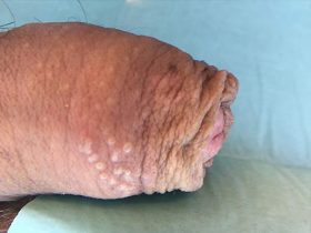 ampollas en el pene por herpes genital fotos