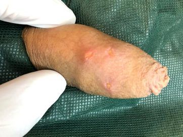 herpes genital hombres