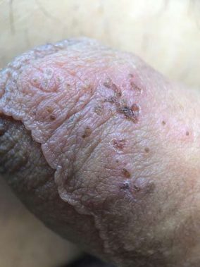 Herpes genital prepucio