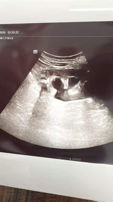 hidronefrosis-ecografia-renal-dilatacion-pielocalicial "Ecografía renal con hidronefrosis mostrando dilatación de la pelvis renal y cálices"
