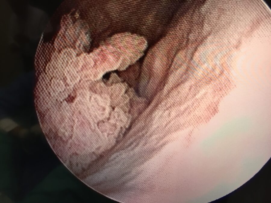 istoscopia-tumor-vejiga “Imagen endoscópica de tumor de vejiga observada mediante cistoscopia”