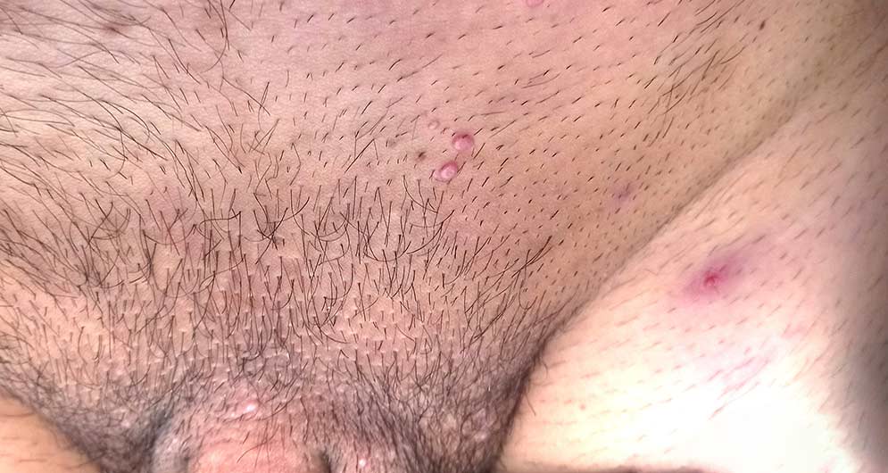 Molusco contagioso 8 molusco contagioso genitales