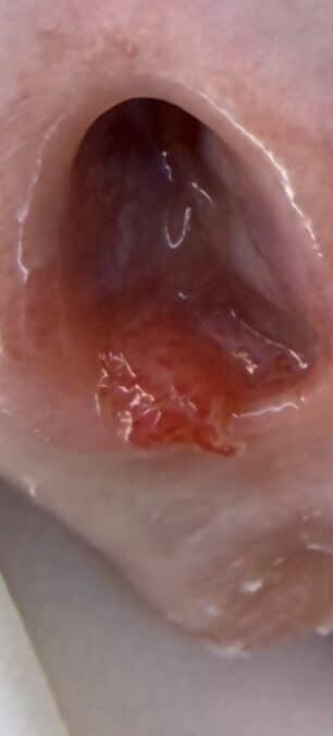 Verrugas en la uretra y su relación con el virus del papiloma 6 Papiloma en meato uretral