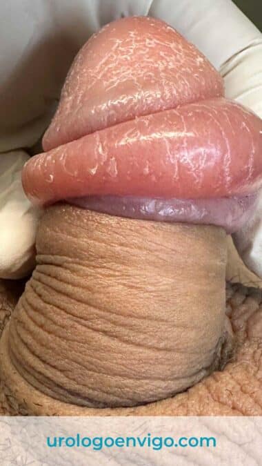 Foto en la que se observa una parafimosis