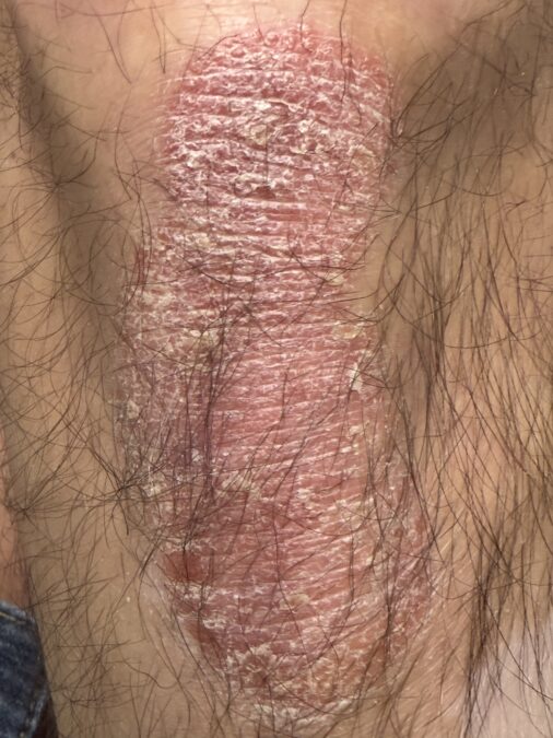 Lesiones de psoriasis en rodilla con placas eritematosas bien delimitadas y descamación característica