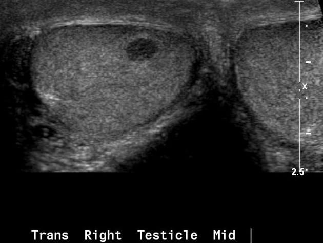Tumor de células de Leydig del testículo 3 resonancia magnética testicular T2 mostrando lesión intratesticular compatible con tumor de células de Leydig