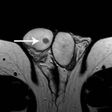 Tumor de células de Leydig del testículo 5 resonancia magnética testicular T2 mostrando lesión intratesticular compatible con tumor de células de Leydig