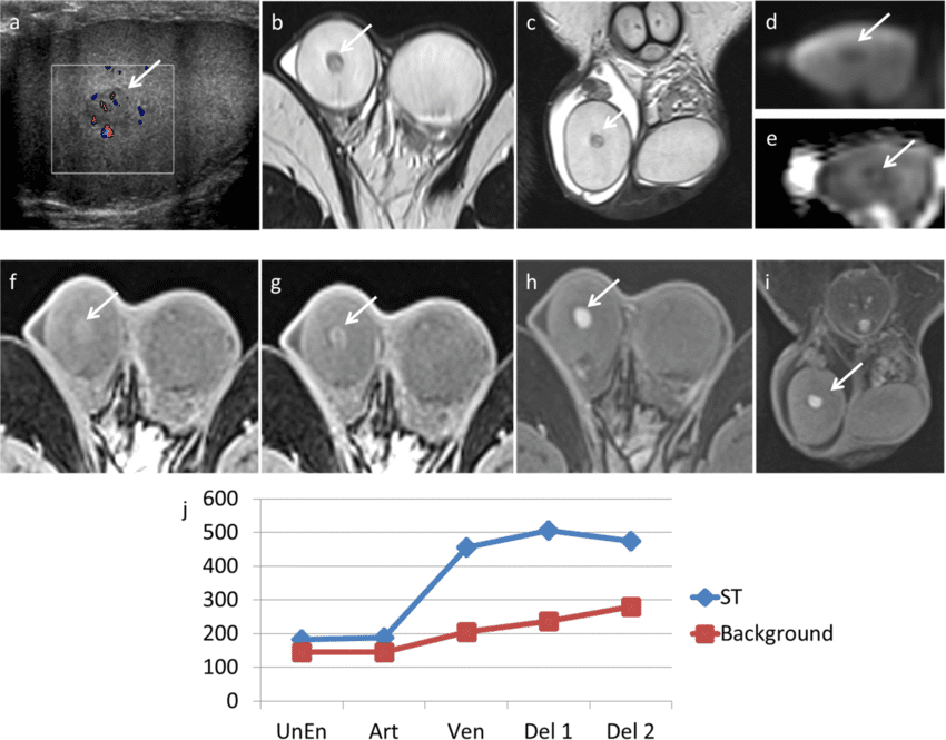 Tumor de células de Leydig del testículo 4 resonancia magnética axial mostrando masa intratesticular compatible con tumor de células de Leydig