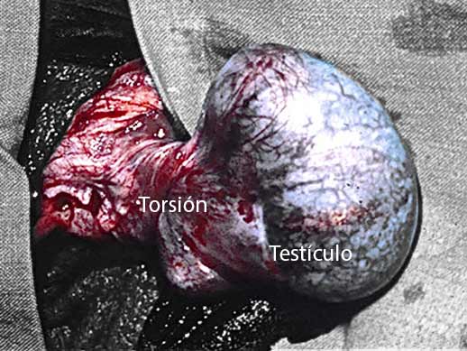 Torsión testicular 3 torsion testicular
