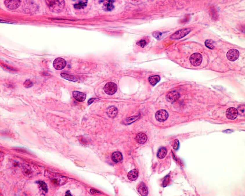 Tumor de células de Leydig del testículo 7 Tumor de células de Leydig del testículo 2