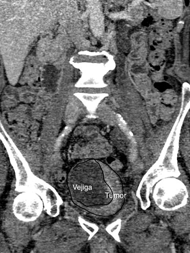 cáncer-vejiga-infiltrante Imagen obtenida mediante TAC de tumor de vejiga iniltrante