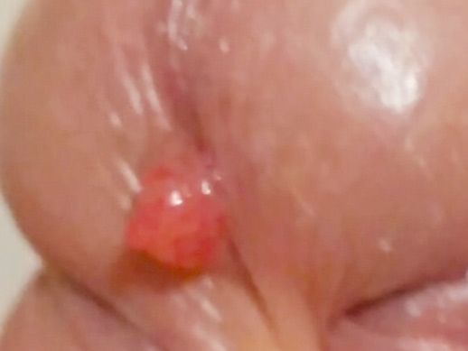 Verrugas en la uretra y su relación con el virus del papiloma 4 lesion roja en la uretra