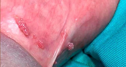verrugas genitales hpv